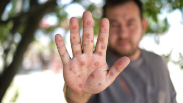 DSÖ: Avrupa'da Maymun Çiçeği Virüsü Tespit Edildi