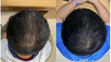 Kelliğe Umut: 2 Ayda Saç Çıkaran Formül Geliştirildi