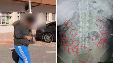 Midesinden 433 Gram Metamfetamin &Ccedil;ıktı