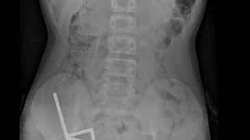 R&ouml;ntgende Tespit Edildi: &Ccedil;ocuğun Bağırsaklarından &Ccedil;ıkanlar Doktorları Şaşırttı