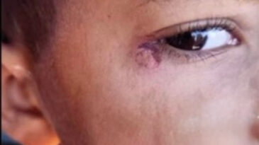 Vahşet: &Ouml;ğrencinin Y&uuml;z&uuml;nde Sigara S&ouml;nd&uuml;r&uuml;ld&uuml;ğ&uuml; İddiasıyla Tutuklama