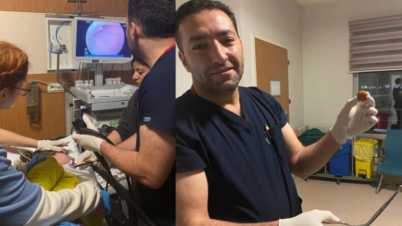 Yemek Borusuna Kaçan Ceviz, Endoskopik Operasyonla Başarıyla Çıkarıldı