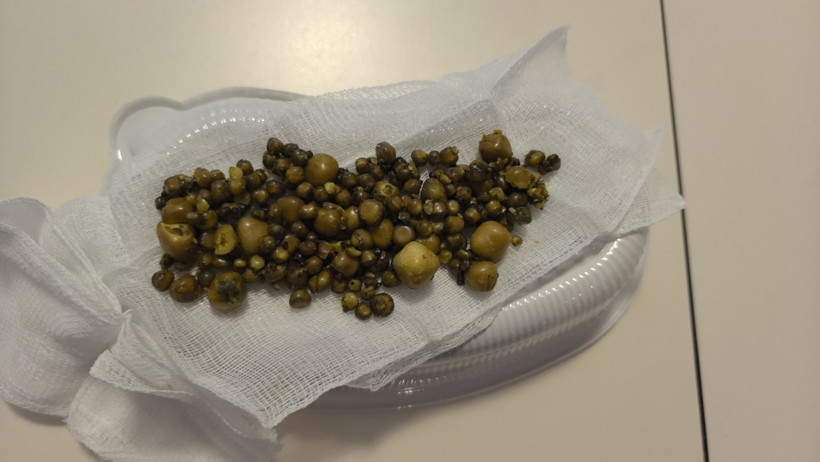 Safra kesesi taşları