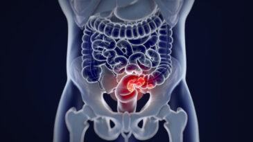 50 Yaş Altı Kadınlar İ&ccedil;in Kolorektal Kanser Riski Artıyor