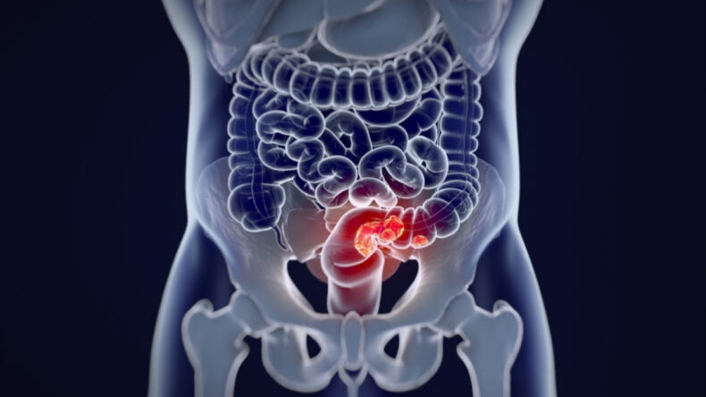 50 Yaş Altı Kadınlar İçin Kolorektal Kanser Riski Artıyor