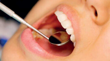 İnsan V&uuml;cudu İ&ccedil;in &Ccedil;ığır A&ccedil;an Keşif: Diş &Ccedil;&uuml;r&uuml;mesine Karşı Yeni Form&uuml;l