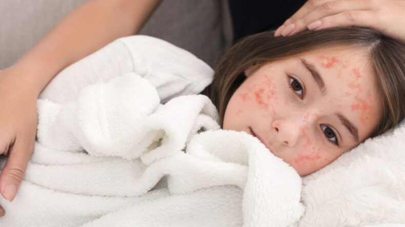 Kızamık Vaka Sayılarında Tehlikeli Artış, DS&Ouml;'den &Ouml;nemli Uyarı