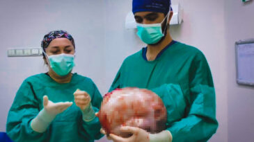 Şule Akgül'ün Karnından Çıkarılan Kitle Şaşkınlık Yarattı