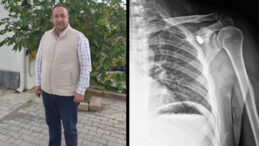 Yıllar Sonra Vücudundan Mermi Çıkarıldı