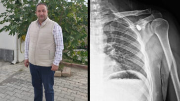 Yıllar Sonra V&uuml;cudundan Mermi &Ccedil;ıkarıldı
