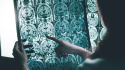 Alzheimer İla&ccedil; Gelişimi İ&ccedil;in Milyar Dolarlık Anlaşma