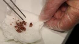 Ameliyat Oldu, Burnundan &Ccedil;ıkanlar Şaşırttı