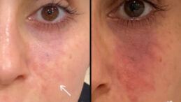 Estetik dolguda kritik uyarı: K&ouml;rl&uuml;k riski g&uuml;n y&uuml;z&uuml;ne &ccedil;ıktı