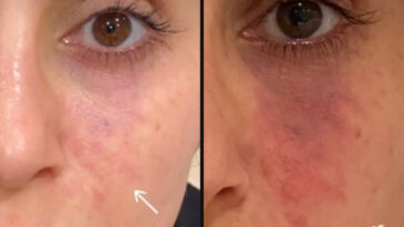 Estetik dolguda kritik uyarı: K&ouml;rl&uuml;k riski g&uuml;n y&uuml;z&uuml;ne &ccedil;ıktı