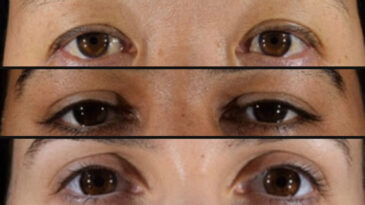 G&ouml;z &Ccedil;evresi Yaşın Belirleyicisi: Gen&ccedil; Misin, Orta Yaşlı Mı?