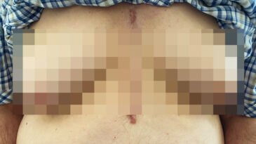 Tıp D&uuml;nyasında Şok: 76 Yaşındaki Adamın Meme B&uuml;y&uuml;mesi