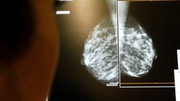 Meme Kanseri Taramalarında Fark Yaratıldı: Ge&ccedil; Teşhis Riski Y&uuml;zde 12 Azaldı