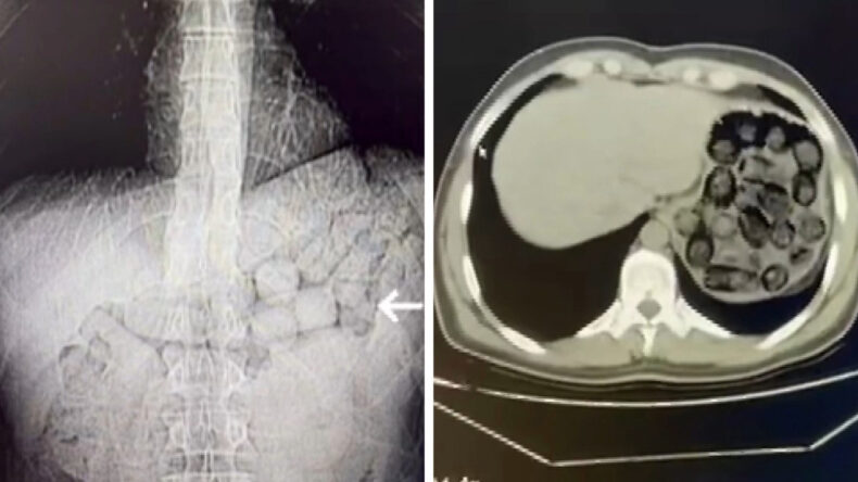 Mide ve Bağırsaklarından 91 Kaps&uuml;l Metamfetamin &Ccedil;ıktı