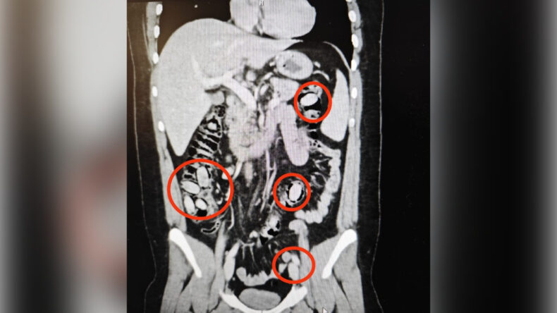 Midesinde 44 Kaps&uuml;l Uyuşturucu Bulundu