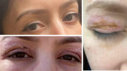 G&uuml;zellik Salonu İşlemi Sonrası G&ouml;z Hasarı İddiası, Şikayet Reddedildi