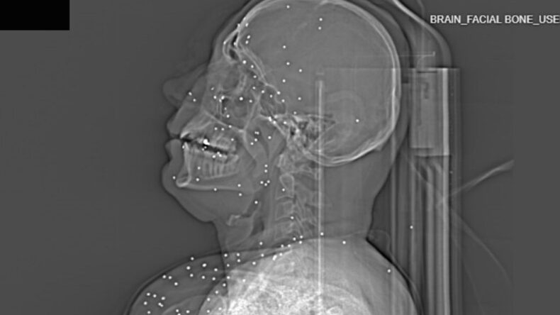 Protestoculara Y&ouml;nelik Şiddetin Boyutu R&ouml;ntgen G&ouml;r&uuml;nt&uuml;lerinde Ortaya &Ccedil;ıktı