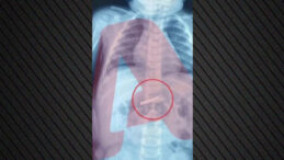 3 yaşındaki &ccedil;ocuk jilet yuttu