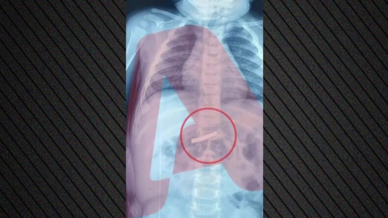 3 yaşındaki &ccedil;ocuk jilet yuttu