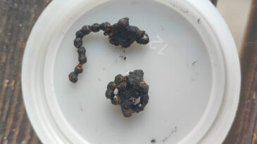 5 Yaşındaki &Ccedil;ocuğun Burnundan &Ccedil;ıkan Cisim Hayrete D&uuml;ş&uuml;rd&uuml;