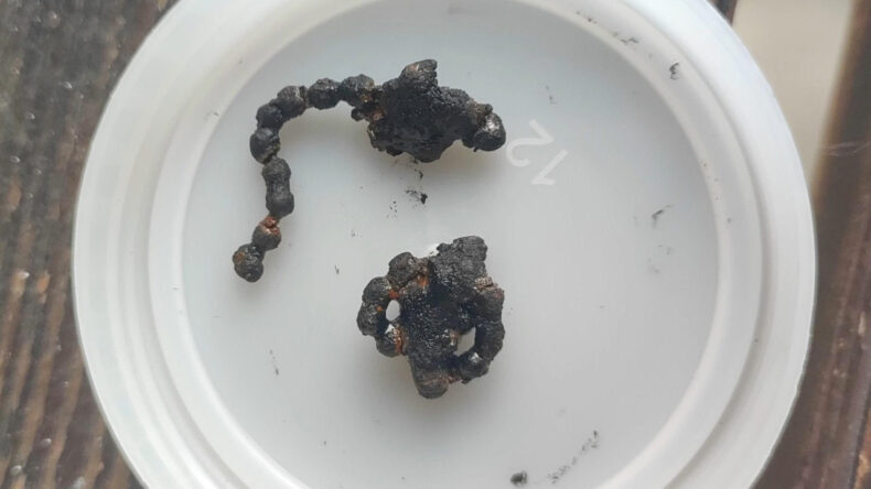 5 Yaşındaki &Ccedil;ocuğun Burnundan &Ccedil;ıkan Cisim Hayrete D&uuml;ş&uuml;rd&uuml;