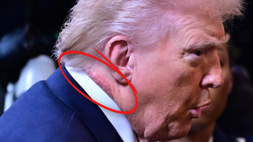 Trump'ın boynundaki kızarıklık