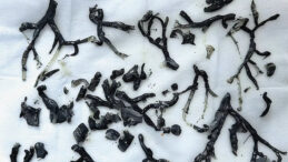 Akciğerlerinden &Ccedil;ıkan Tıp D&uuml;nyasını Şaşkına &Ccedil;evirdi