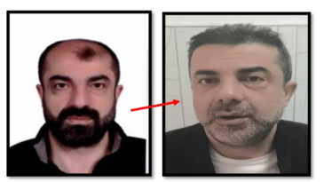 Ameliyatla Kardeşine Benzedi, 7 Yıl Ka&ccedil;tı