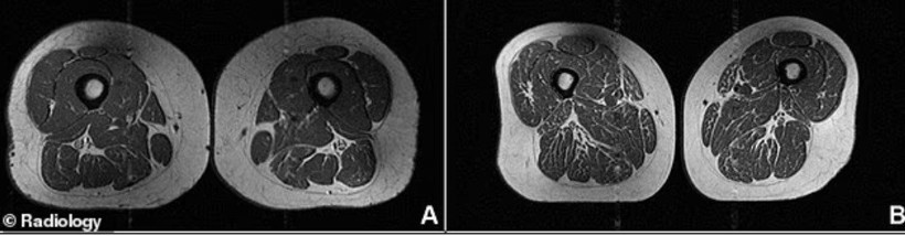 Aşırı işlenmiş gıdalar ve kas sağlığı