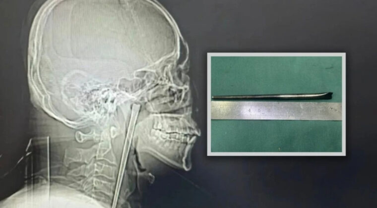 Sekiz Yıl Boğazında Metal &Ccedil;ubukla Yaşadı