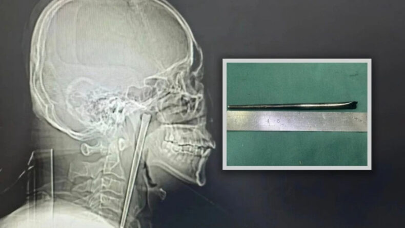 Sekiz Yıl Boğazında Metal &Ccedil;ubukla Yaşadı