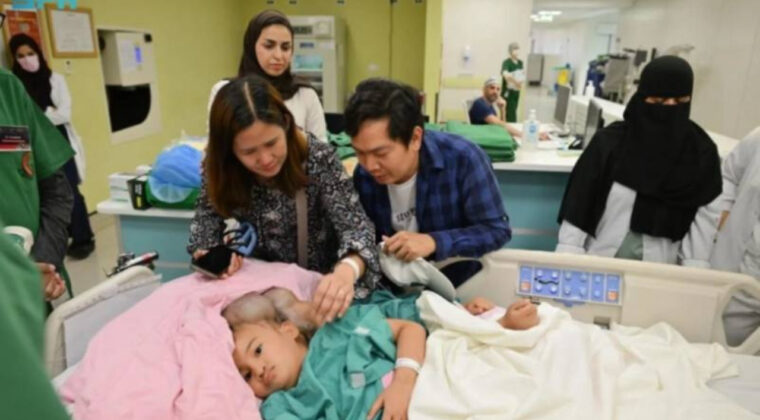 Yapışık ikizleri ayırmak 18,5 saat s&uuml;rd&uuml;